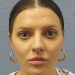 Periorbital Before & After Patient #8541
