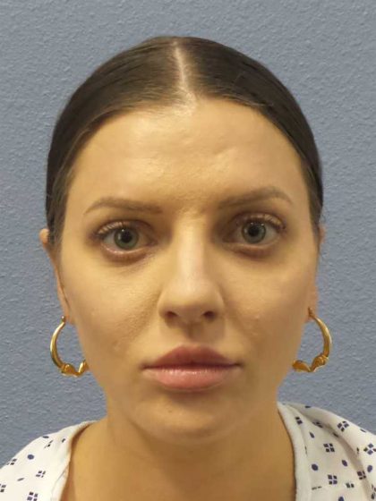 Periorbital Before & After Patient #8541