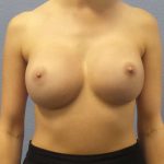 Breast Augmentation Revision (Breast Enlargement Repair) Before & After Patient #7127