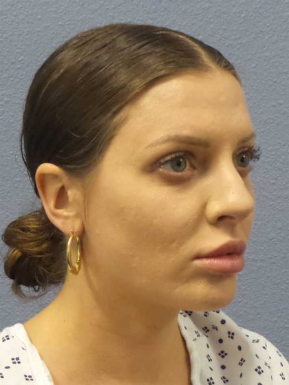 Periorbital Before & After Patient #8541