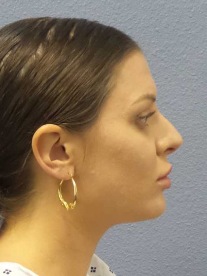 Periorbital Before & After Patient #8541