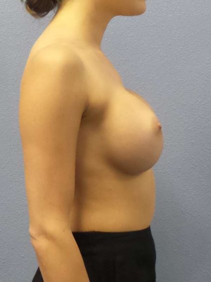 Breast Augmentation Revision (Breast Enlargement Repair) Before & After Patient #7127