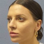 Periorbital Before & After Patient #8541