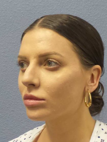 Periorbital Before & After Patient #8541