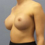Breast Augmentation Revision (Breast Enlargement Repair) Before & After Patient #7127