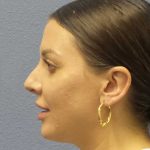 Periorbital Before & After Patient #8541