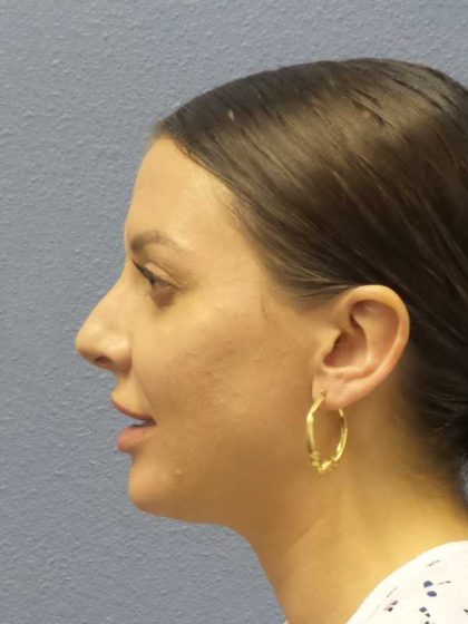 Periorbital Before & After Patient #8541