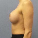 Breast Augmentation Revision (Breast Enlargement Repair) Before & After Patient #7127