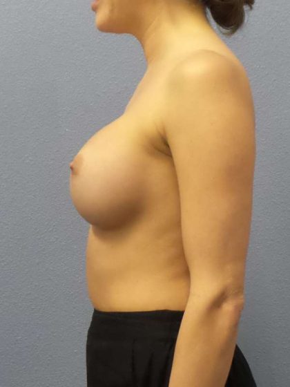 Breast Augmentation Revision (Breast Enlargement Repair) Before & After Patient #7127