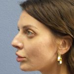 Periorbital Before & After Patient #8541