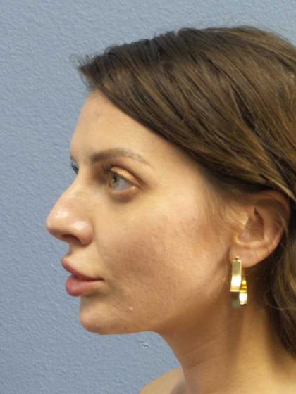 Periorbital Before & After Patient #8541