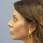 Periorbital Before & After Patient #8541