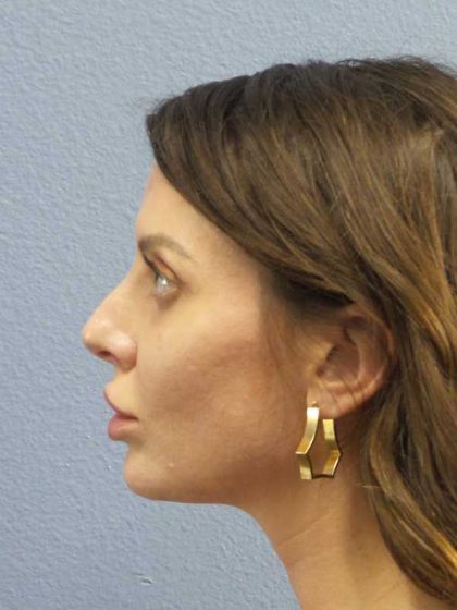Periorbital Before & After Patient #8541