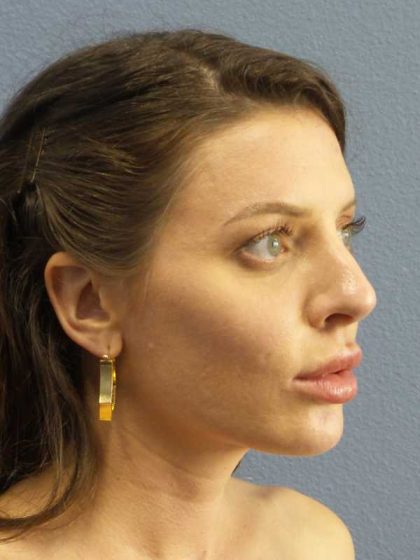 Periorbital Before & After Patient #8541