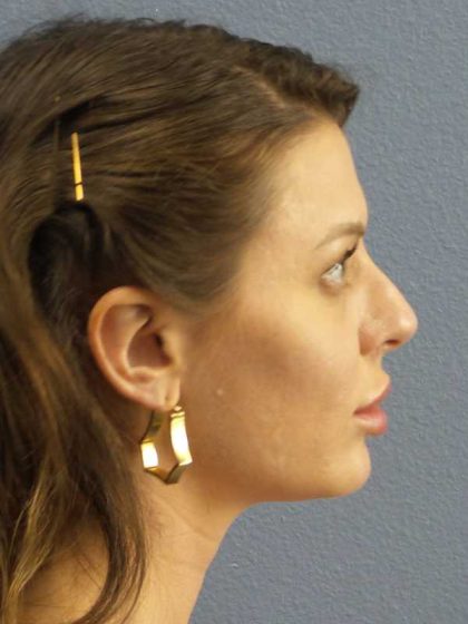 Periorbital Before & After Patient #8541