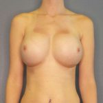 Breast Augmentation Before & After Patient #6100