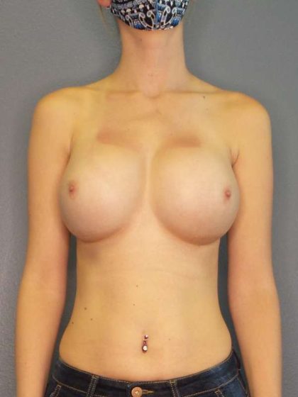 Breast Augmentation Before & After Patient #6100