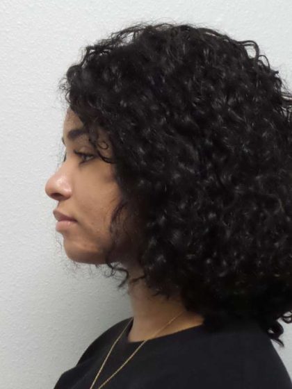 Rhinoplasty Before & After Patient #10165