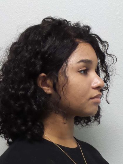 Rhinoplasty Before & After Patient #10165
