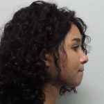 Rhinoplasty Before & After Patient #10165
