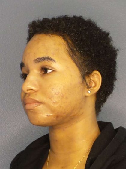 Rhinoplasty Before & After Patient #10165