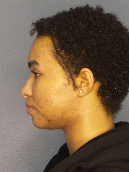 Rhinoplasty Before & After Patient #10165