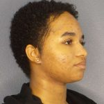 Rhinoplasty Before & After Patient #10165