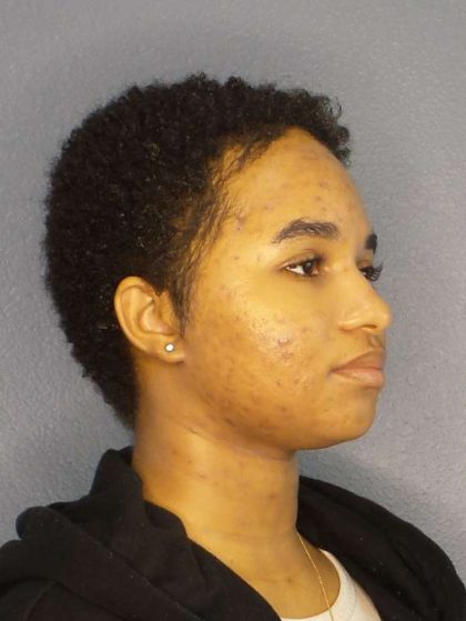 Rhinoplasty Before & After Patient #10165