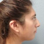 Rhinoplasty Before & After Patient #10049