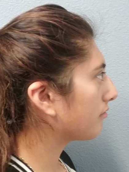 Rhinoplasty Before & After Patient #10049