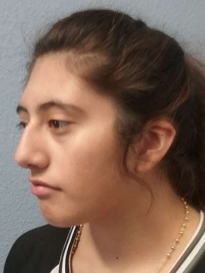Rhinoplasty Before & After Patient #10049