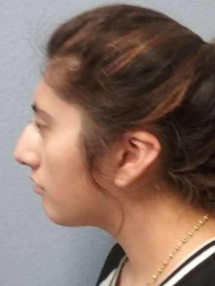 Rhinoplasty Before & After Patient #10049