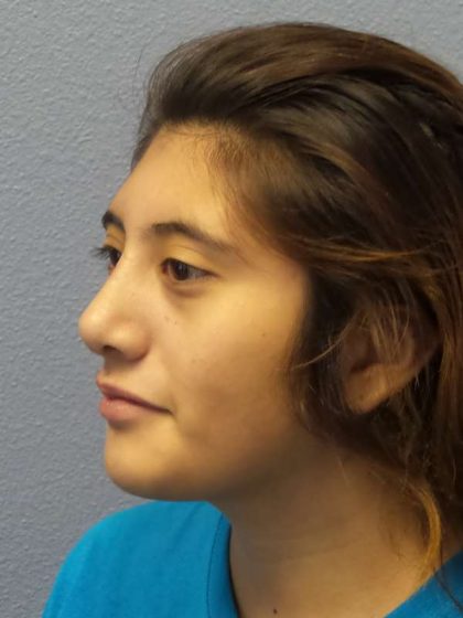 Rhinoplasty Before & After Patient #10049
