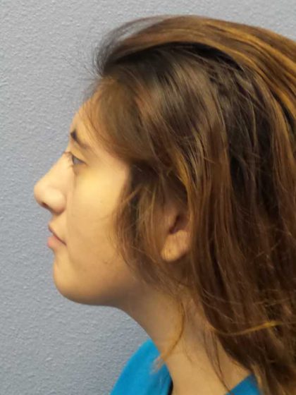 Rhinoplasty Before & After Patient #10049