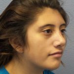 Rhinoplasty Before & After Patient #10049