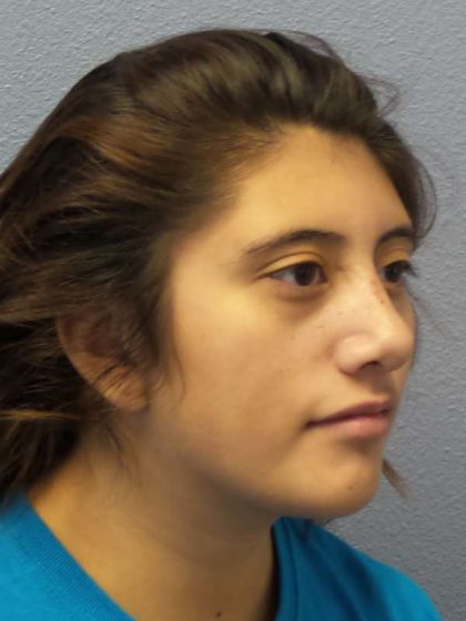 Rhinoplasty Before & After Patient #10049
