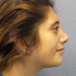 Rhinoplasty Before & After Patient #10049