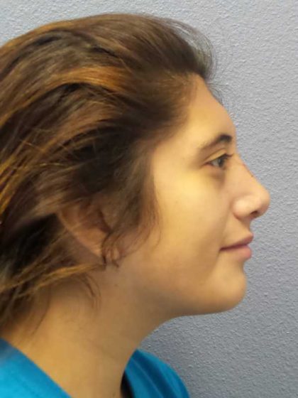 Rhinoplasty Before & After Patient #10049