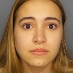 Rhinoplasty Before & After Patient #9794