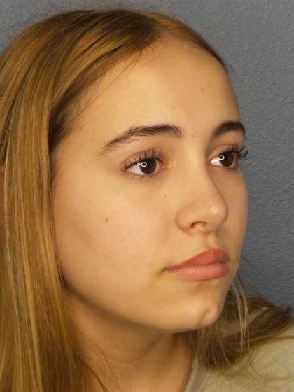 Rhinoplasty Before & After Patient #9794