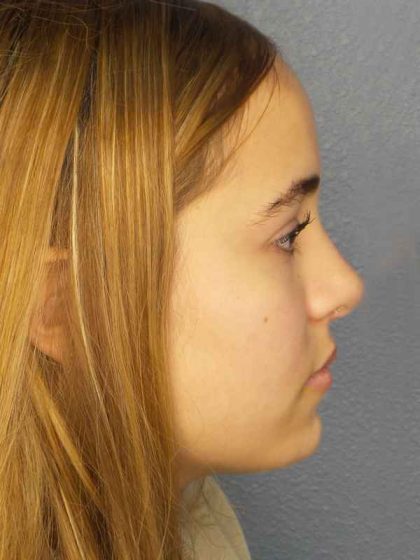 Rhinoplasty Before & After Patient #9794