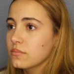Rhinoplasty Before & After Patient #9794