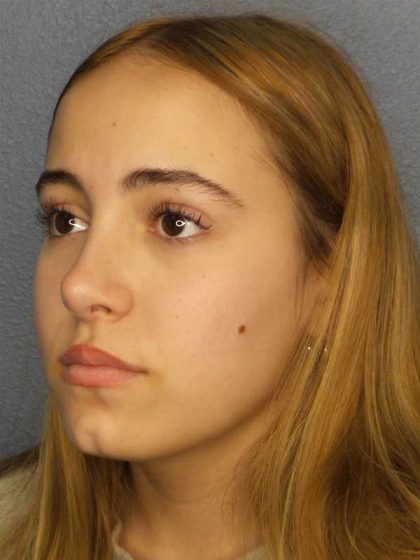 Rhinoplasty Before & After Patient #9794