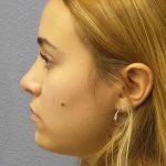 Rhinoplasty Before & After Patient #9794
