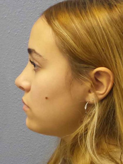 Rhinoplasty Before & After Patient #9794