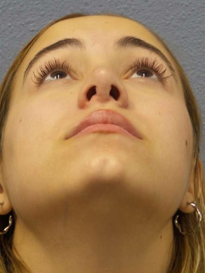Rhinoplasty Before & After Patient #9794