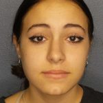 Rhinoplasty Before & After Patient #9794