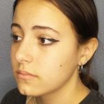 Rhinoplasty Before & After Patient #9794