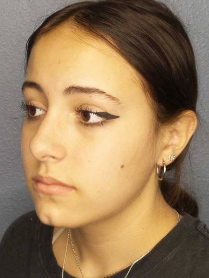 Rhinoplasty Before & After Patient #9794