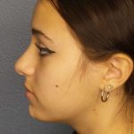 Rhinoplasty Before & After Patient #9794